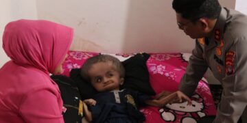 Bhayangkari Peduli, Sentuhan Kasih untuk Anak Penderita Hidrosefalus di Tarakan