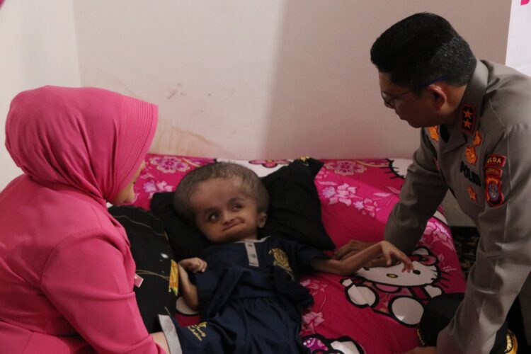 Bhayangkari Peduli, Sentuhan Kasih untuk Anak Penderita Hidrosefalus di Tarakan